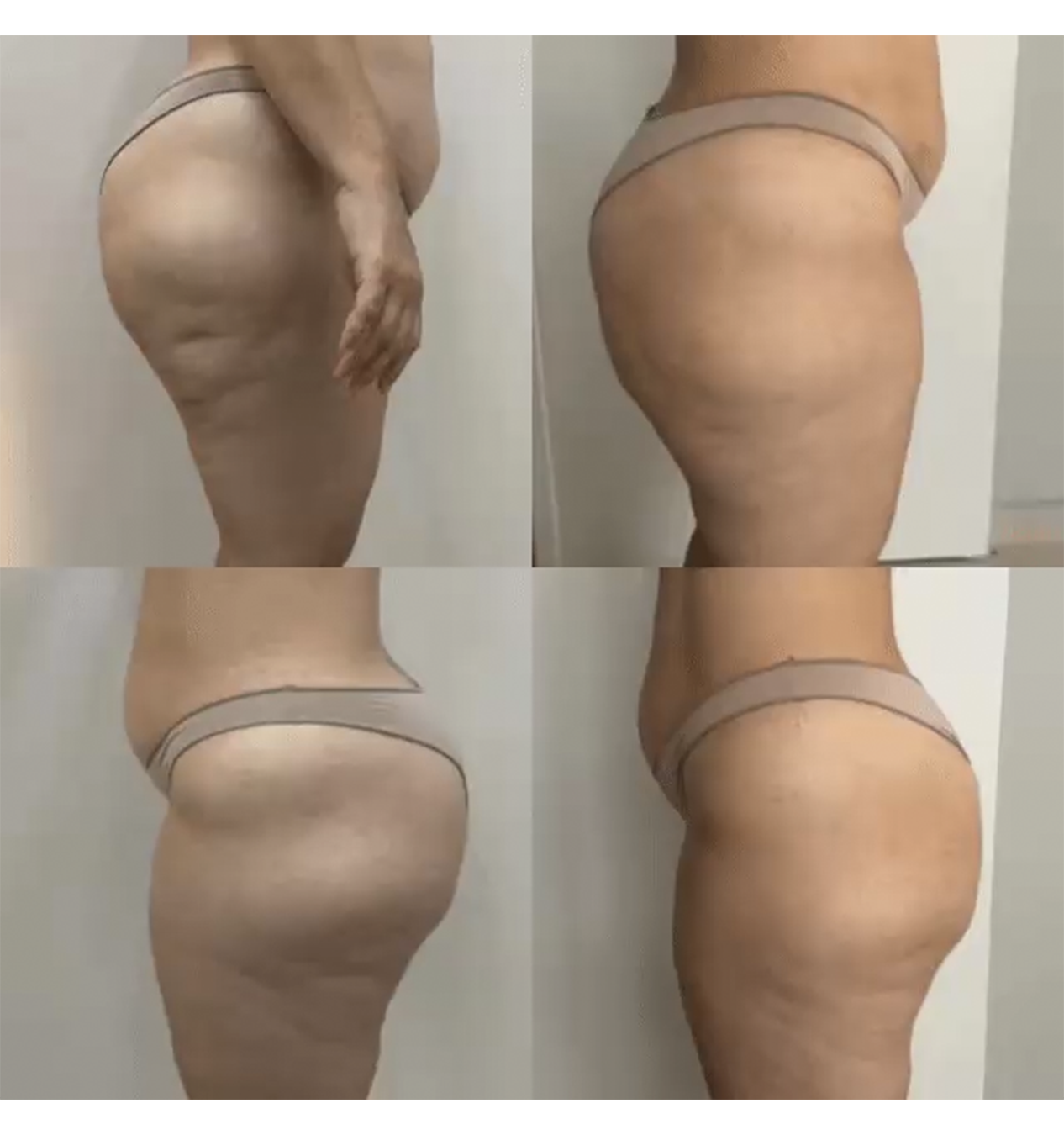 Antes e depois — remodelação corporal
