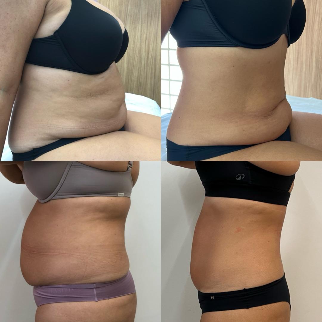 Antes e depois — caso 2