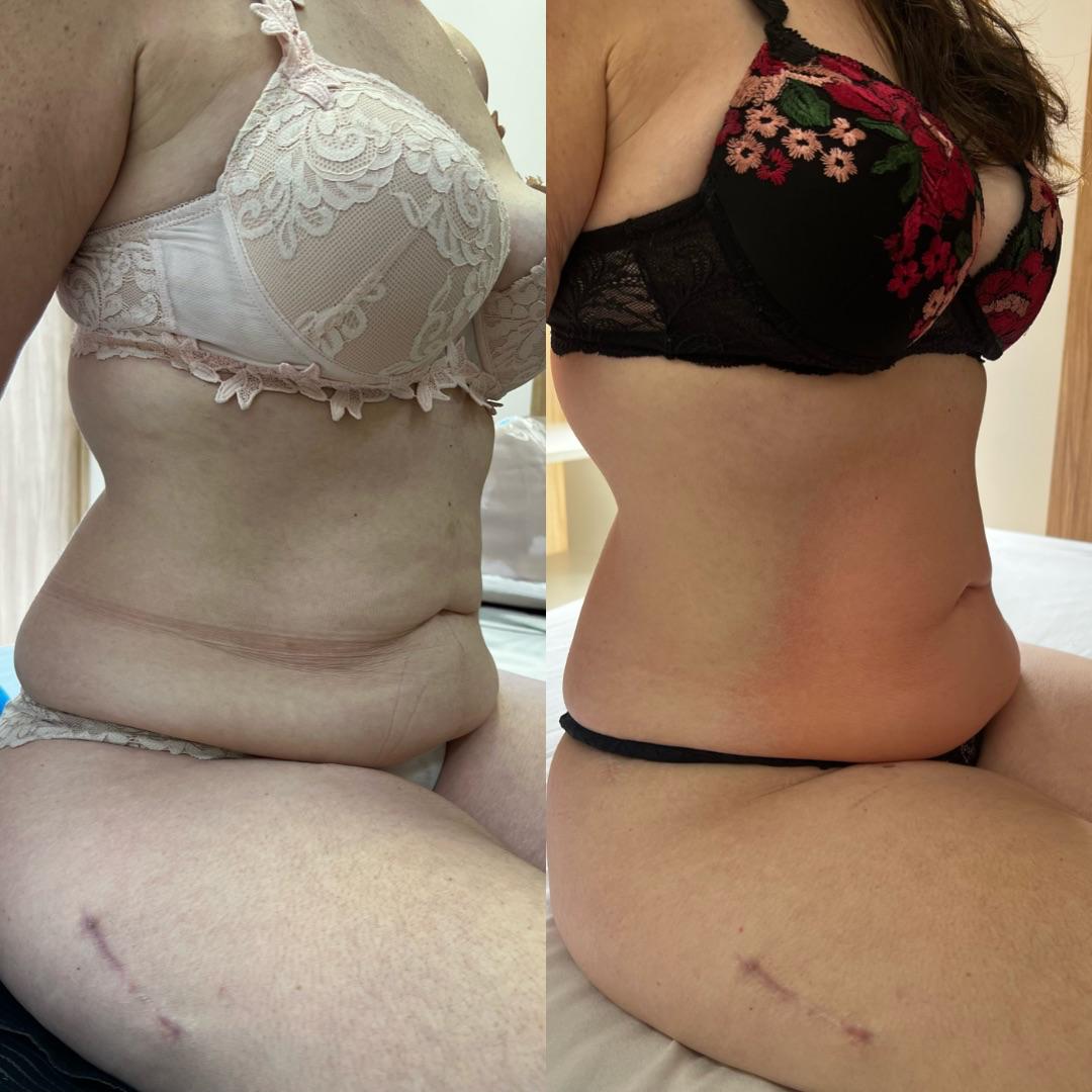 Antes e depois — caso 1